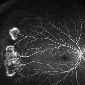 Fundus Fluorescein Angiography