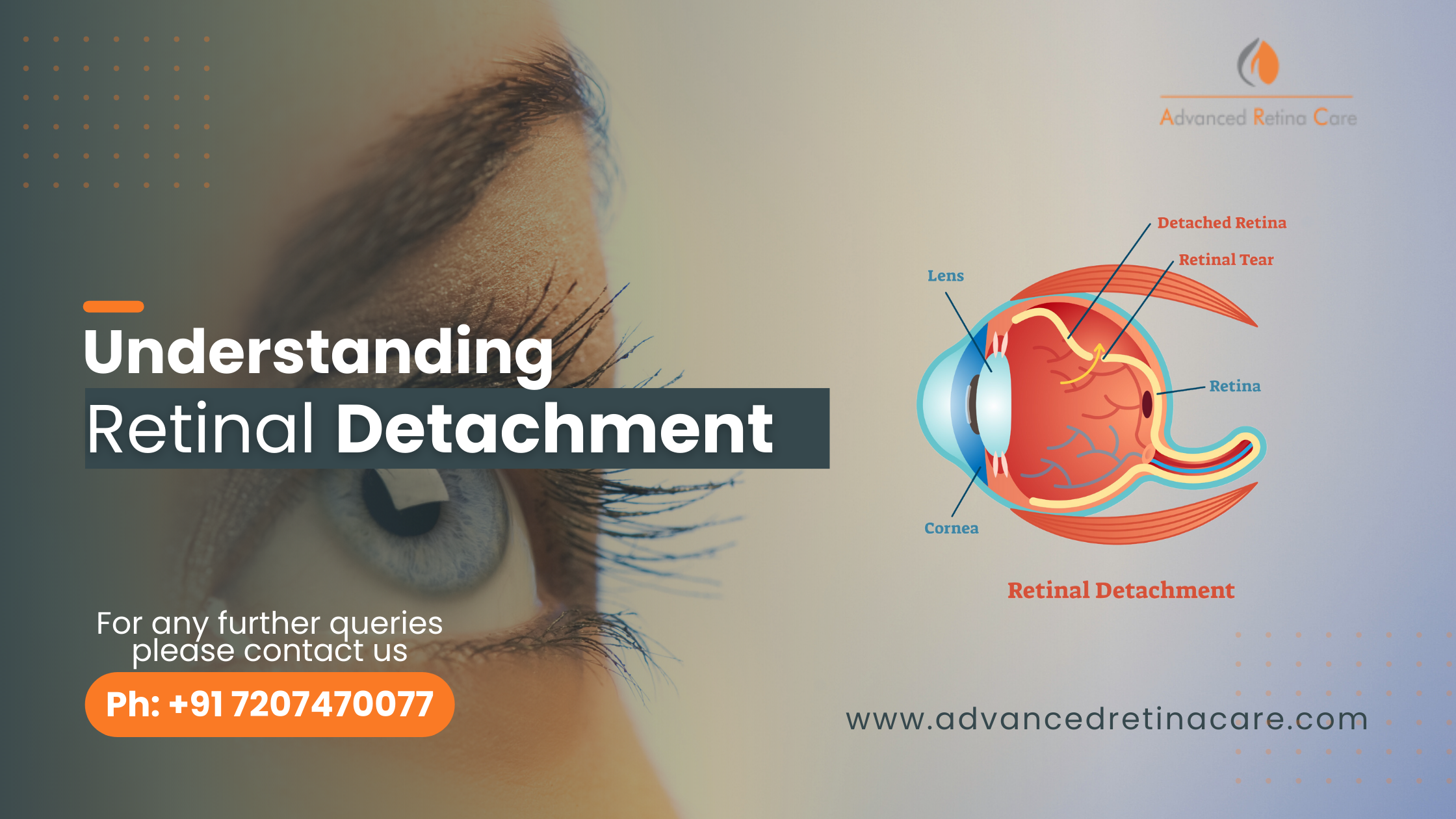 Understanding Retinal Detachment