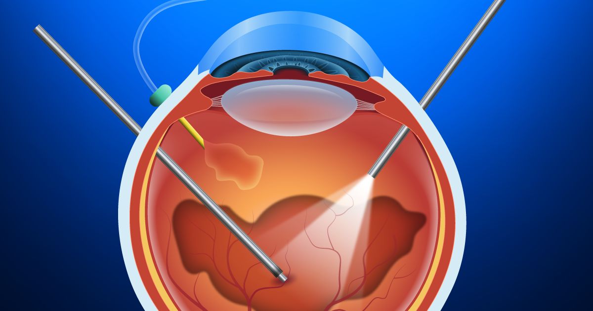 Advanced Retina Surgery Or Vitrectomy