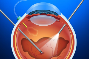 Advanced Retina Surgery Or Vitrectomy