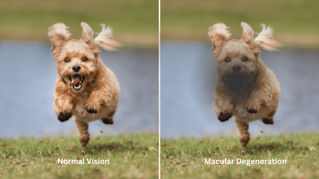 Normal Eye Vision Vs Macular Degeneration